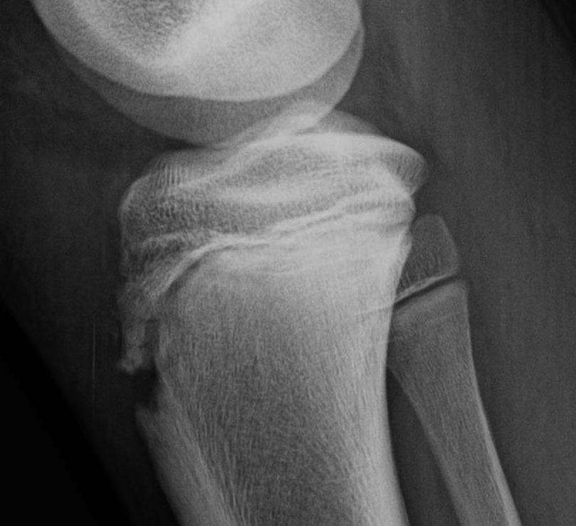 Tibial Tubercle Avulsion Type 1